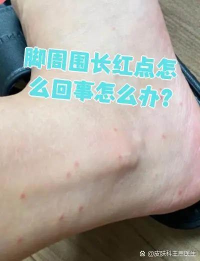 脚部红斑点状泛红改善