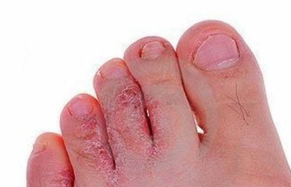 脚部水泡混合型肌肤炎症(图1) 脚部水泡混合型肌肤炎症
