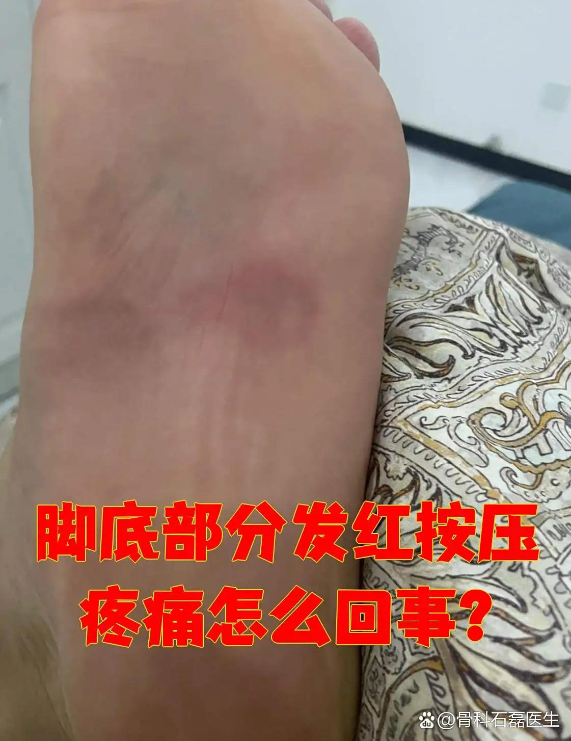 脚部红斑表层发红改善(图1) 脚部红斑表层发红改善