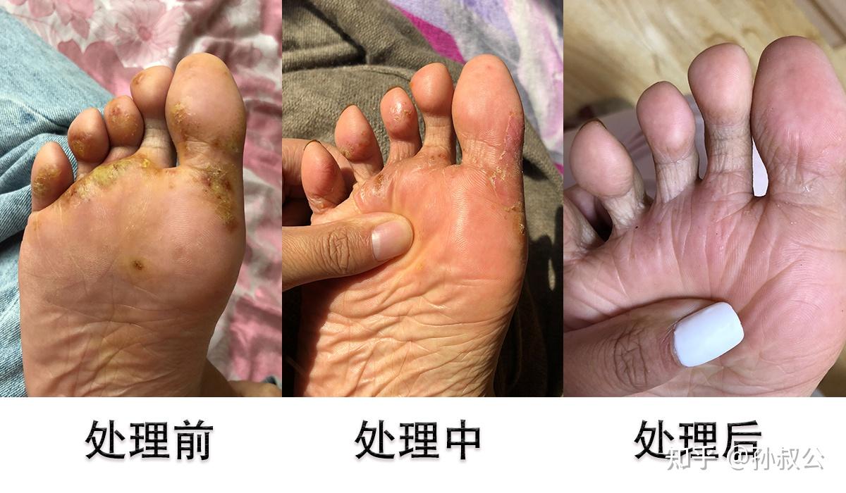 夏季脚臭长效控制(图1) 夏季脚臭长效控制