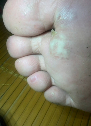 水泡型脚气梅雨季防感染