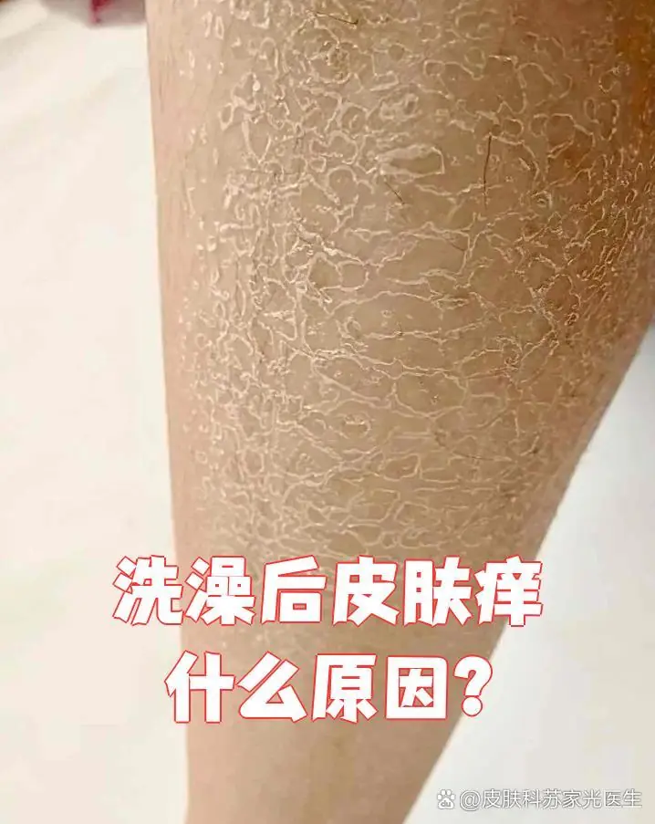 洗澡后脚痒诱发因素(图1) 洗澡后脚痒诱发因素