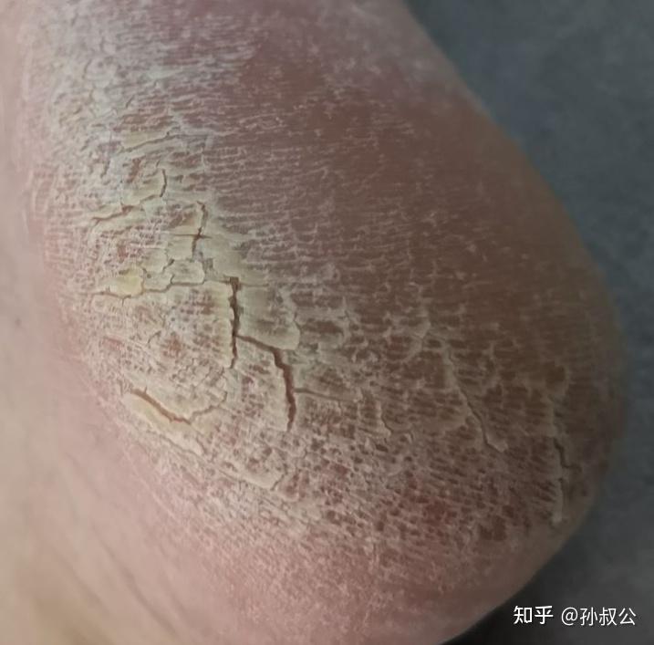 脚部糜烂快速收敛方法