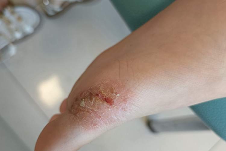 脚部糜烂快速结痂技巧