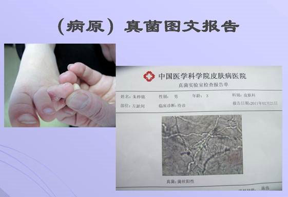 真菌检测排查脚痒
