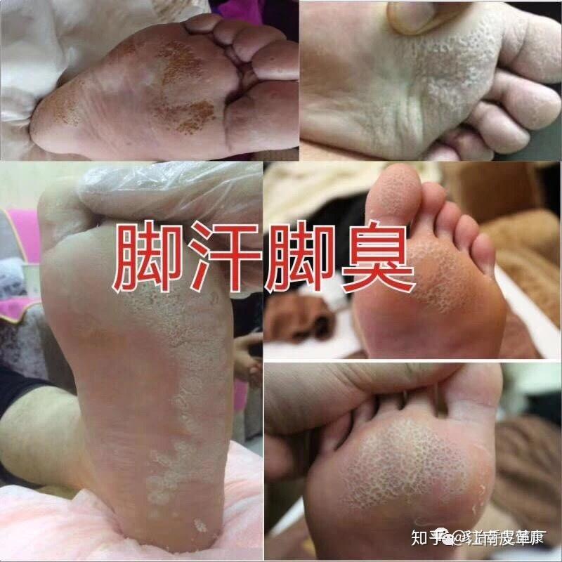 脚部皮肤问题鉴别(图1) 脚部皮肤问题鉴别