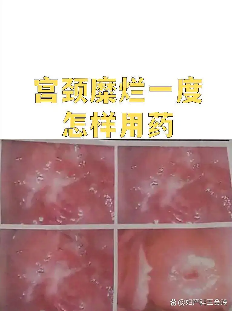 湿热型糜烂快速恢复