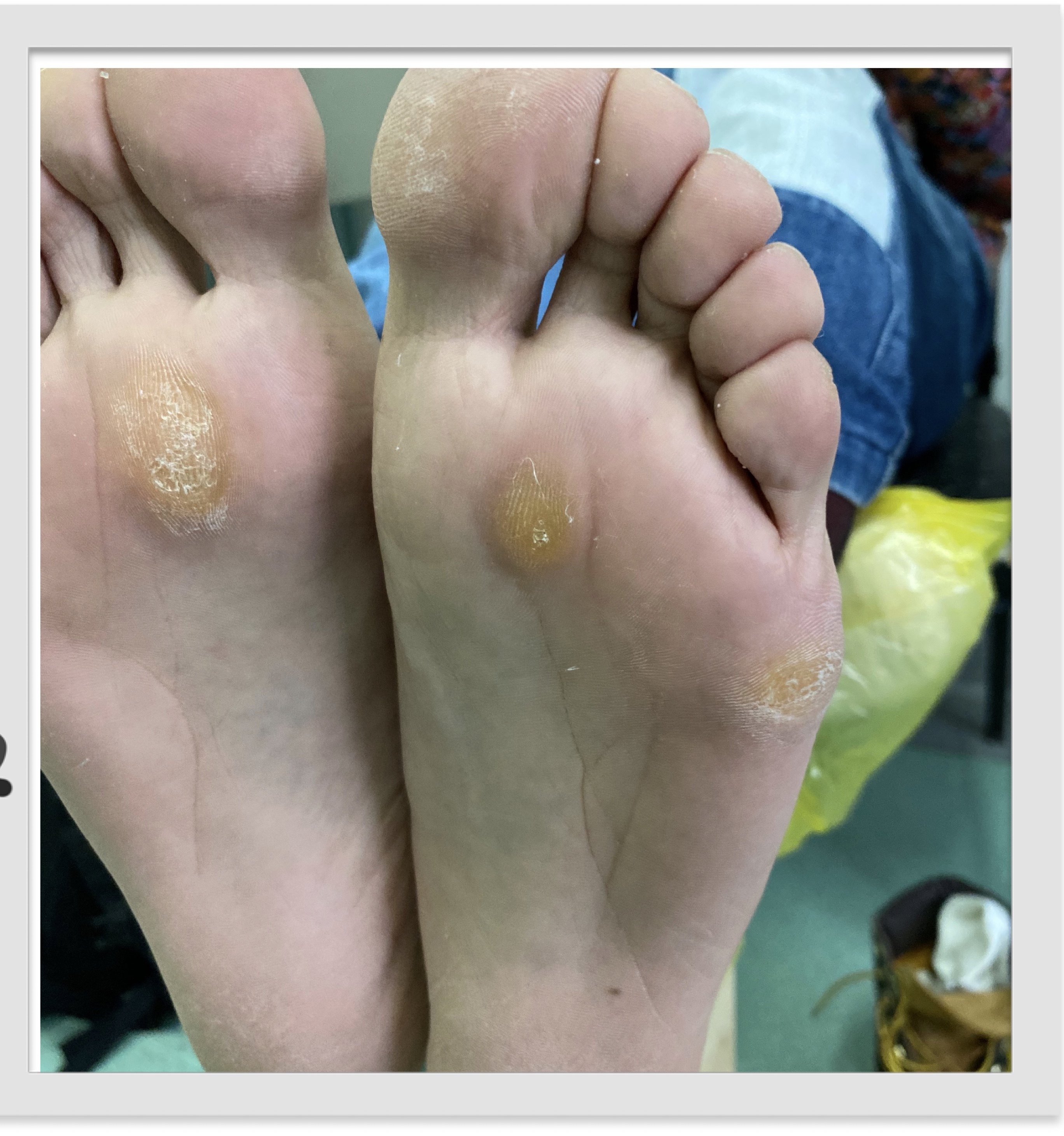 水泡型脚气脚部老茧打磨预防