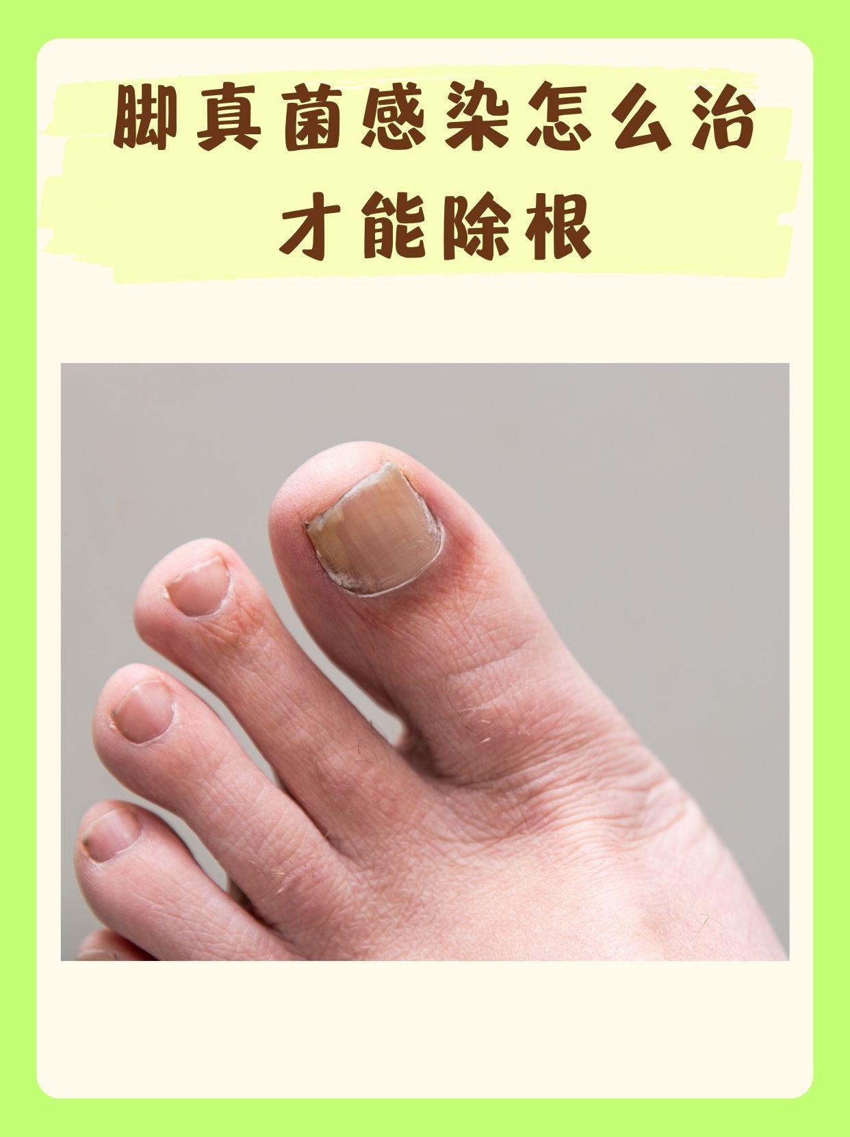 【专题报道】脚部真菌感染的综合治疗方案