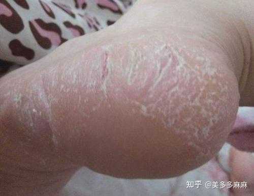 鳞屑型脚气表皮细胞养护