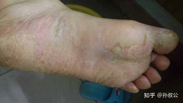 水泡型脚气真菌残留彻底清除