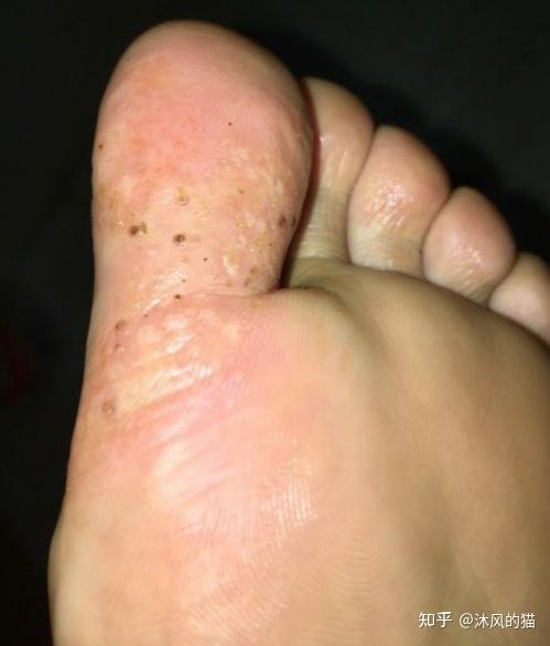 水泡型脚气潮湿季节鞋袜烘干