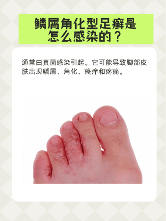 【专题报道】足癣防治的综合治疗方案