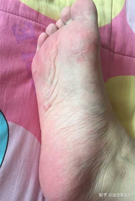 水泡型脚气即时更换潮湿袜子