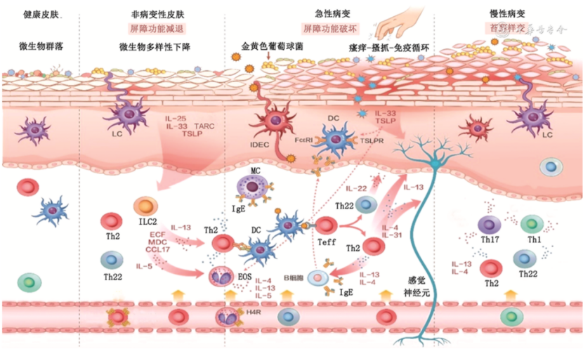红斑型脚气炎症机制