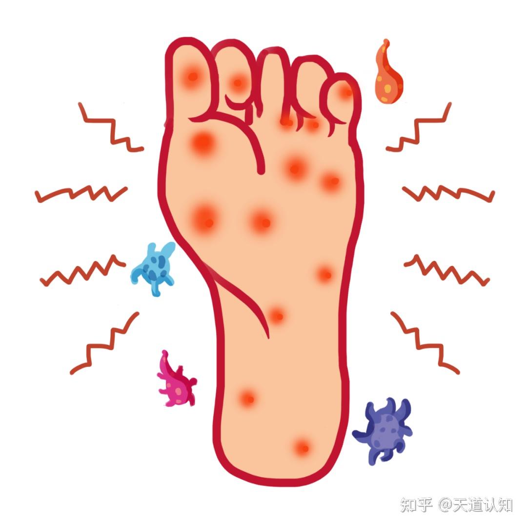 红斑型脚气季节高发原因
