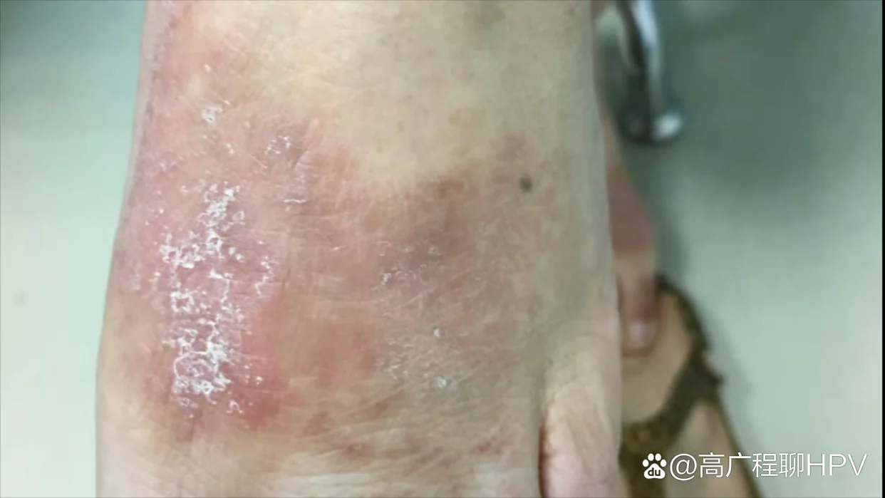 红斑型脚气夏季加重诱因