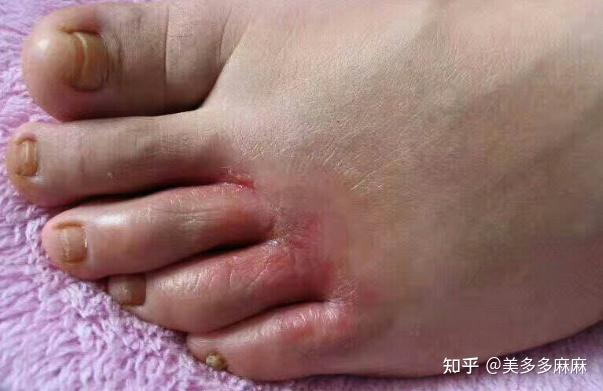 脚部起水泡久蹲压迫成因