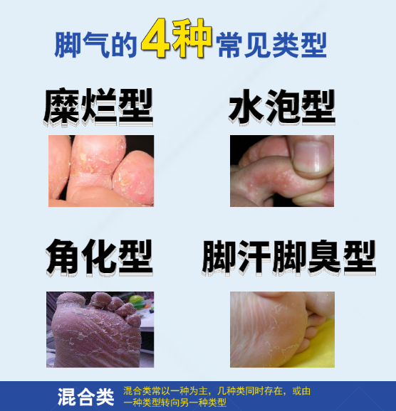 【健康问答】关于混合型脚气的常见疑问