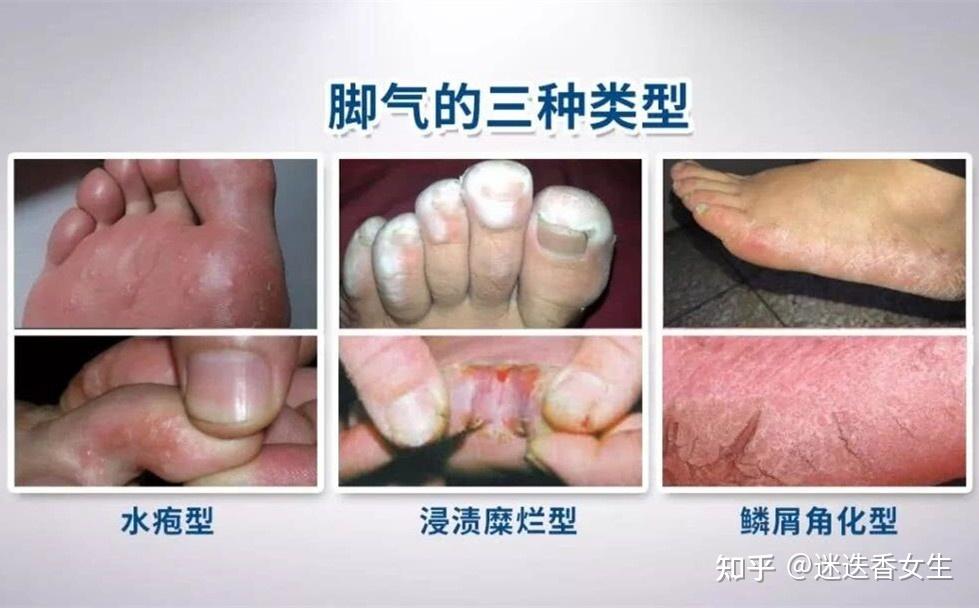 红斑型脚气挤压后炎症扩散