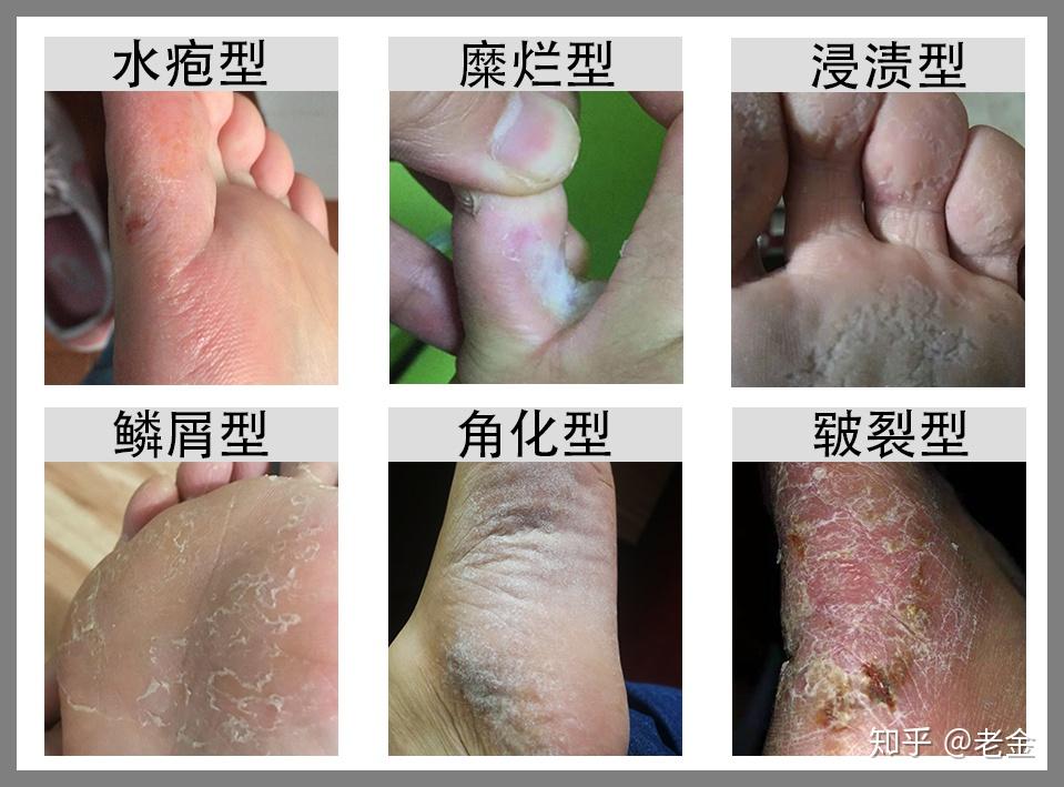 脚部起水泡表皮葡萄球菌诱发