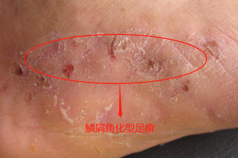 红斑型脚气合并汗疱疹成因