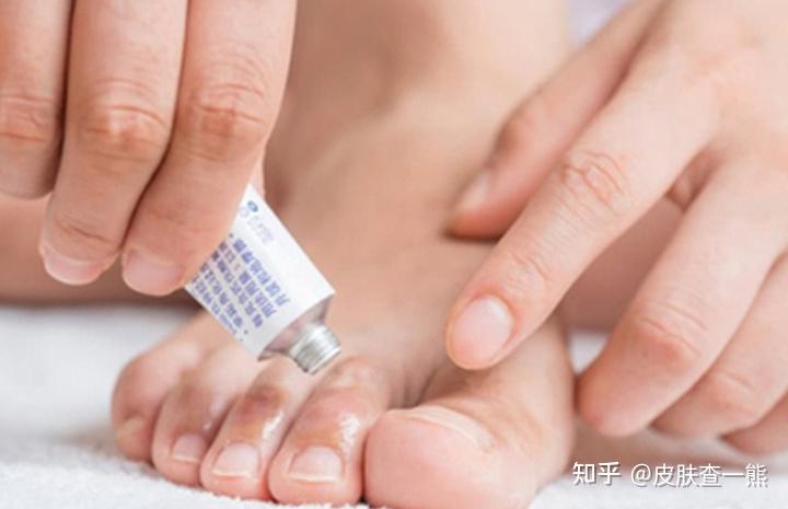 【医学前沿】脚气用药的最新研究成果(图1) 【医学前沿】脚气用药的最新研究成果