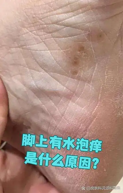 脚部起水泡外用膏剂过敏