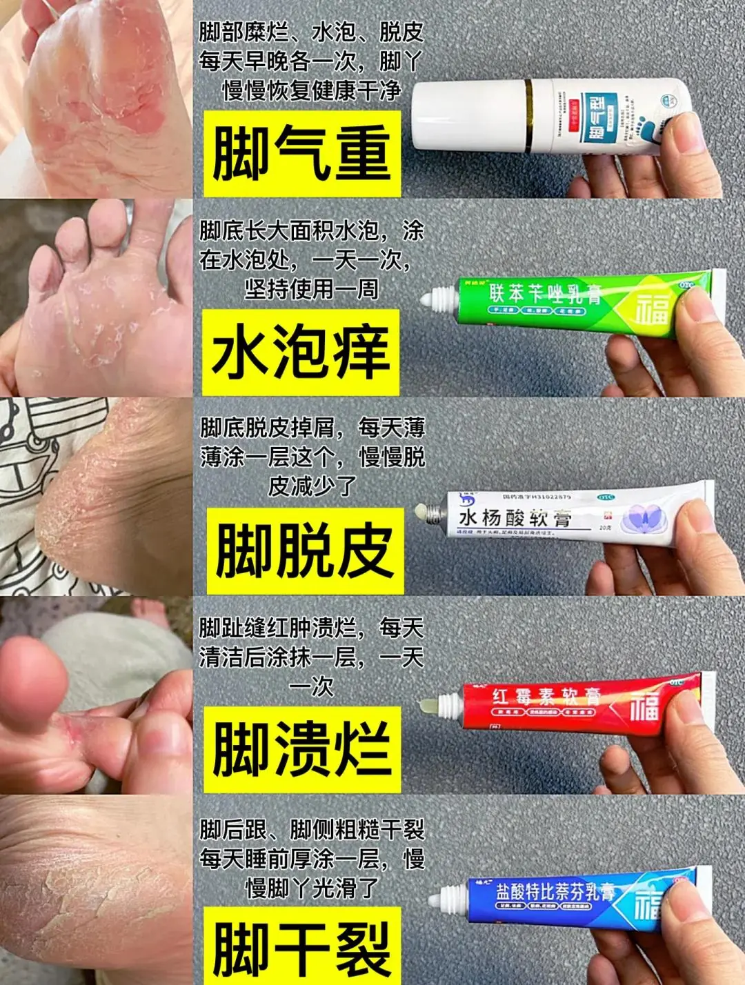 红斑型脚气保湿方法