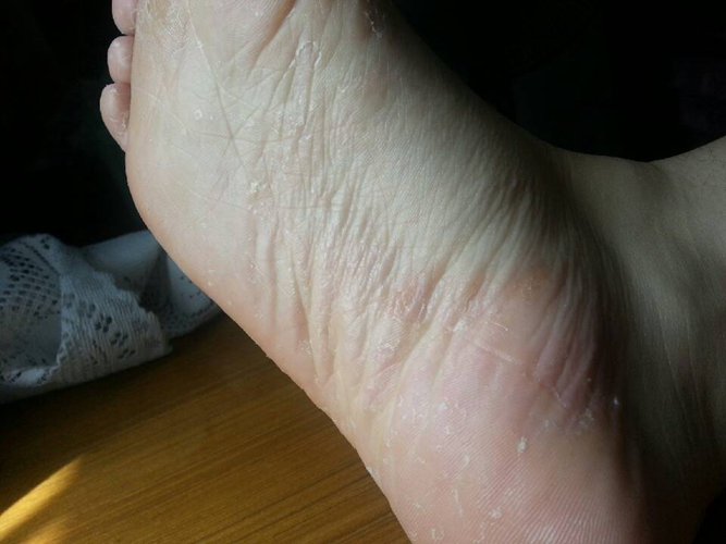 脚部起水泡长期闷捂表皮发白