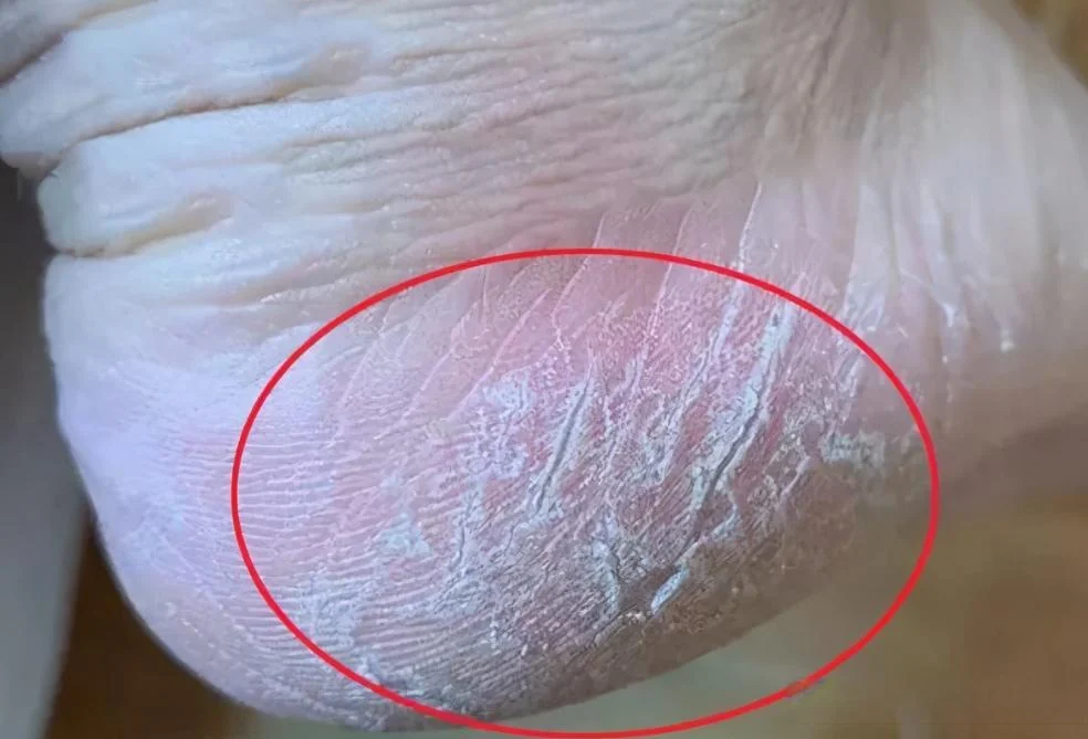 改善脚趾粗糙脱屑(图1) 改善脚趾粗糙脱屑