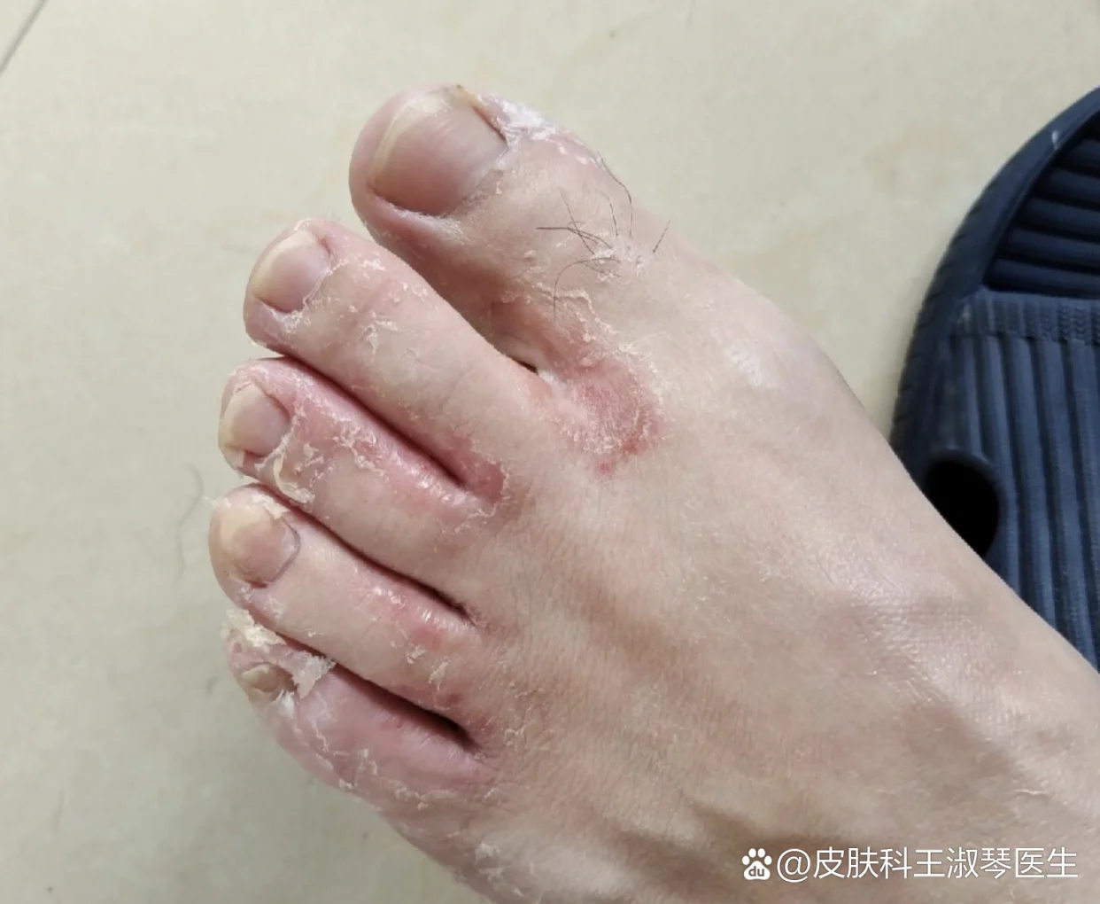 改善脚缝白皮堆积(图1) 改善脚缝白皮堆积