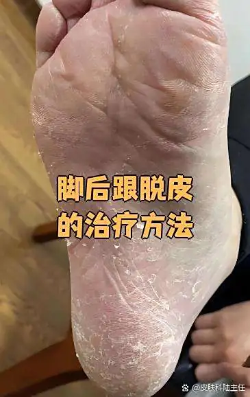 改善脚跟厚皮脱落