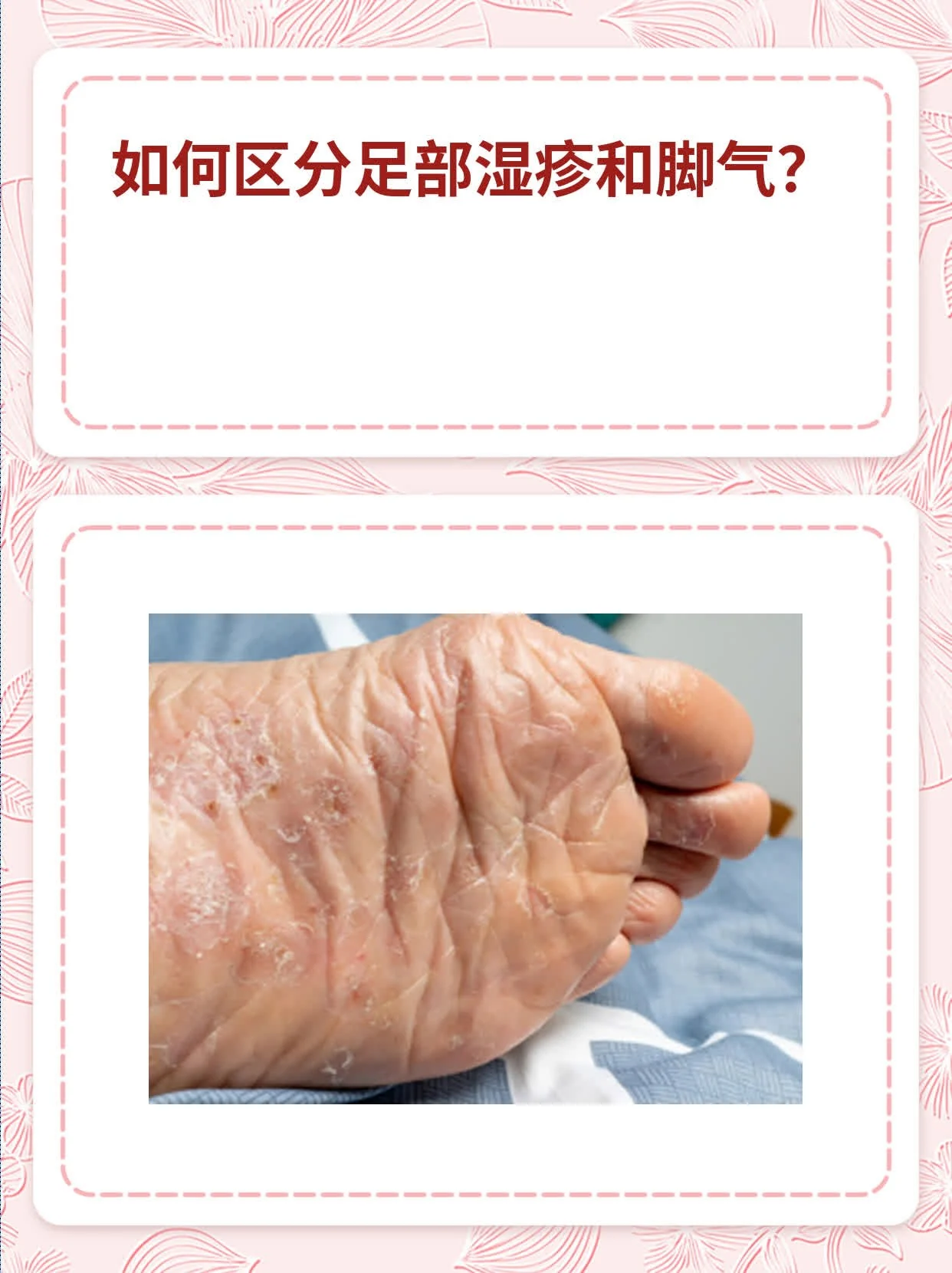 脚部异味湿气郁结成因(图1) 脚部异味湿气郁结成因