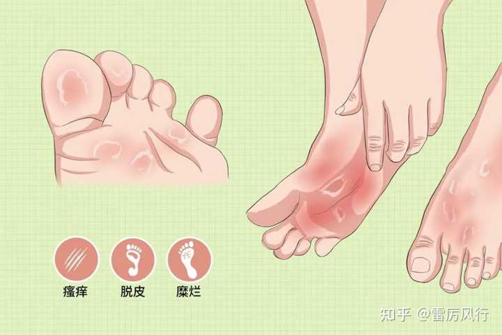 脚部起水泡瘙痒抓挠破损起疱(图1) 脚部起水泡瘙痒抓挠破损起疱