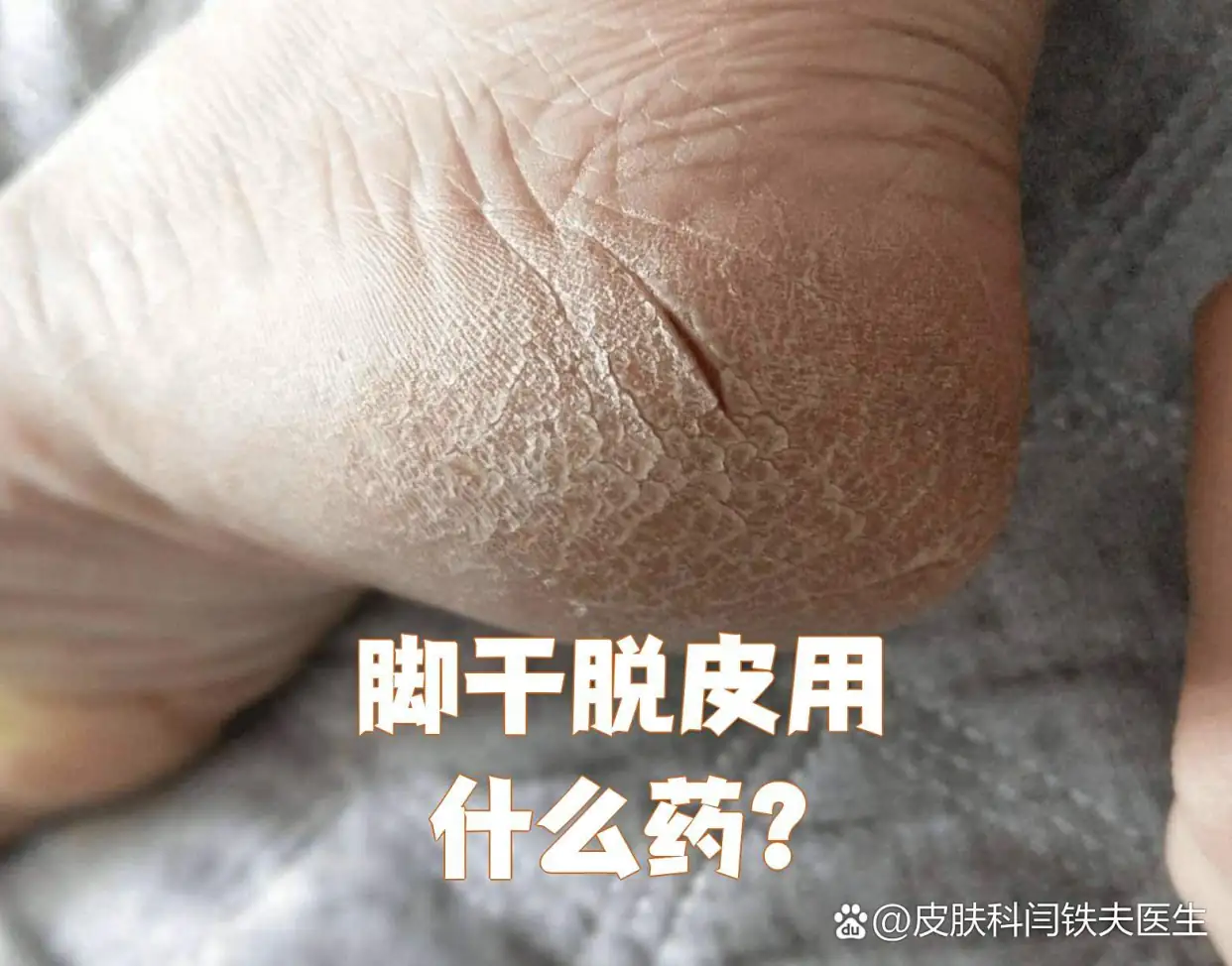 改善脚背干屑脱落(图1) 改善脚背干屑脱落