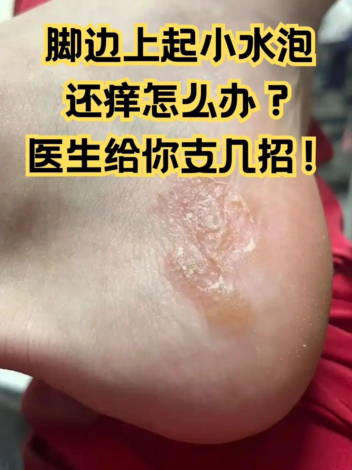 脚部起水泡针尖式小水泡成因(图1) 脚部起水泡针尖式小水泡成因