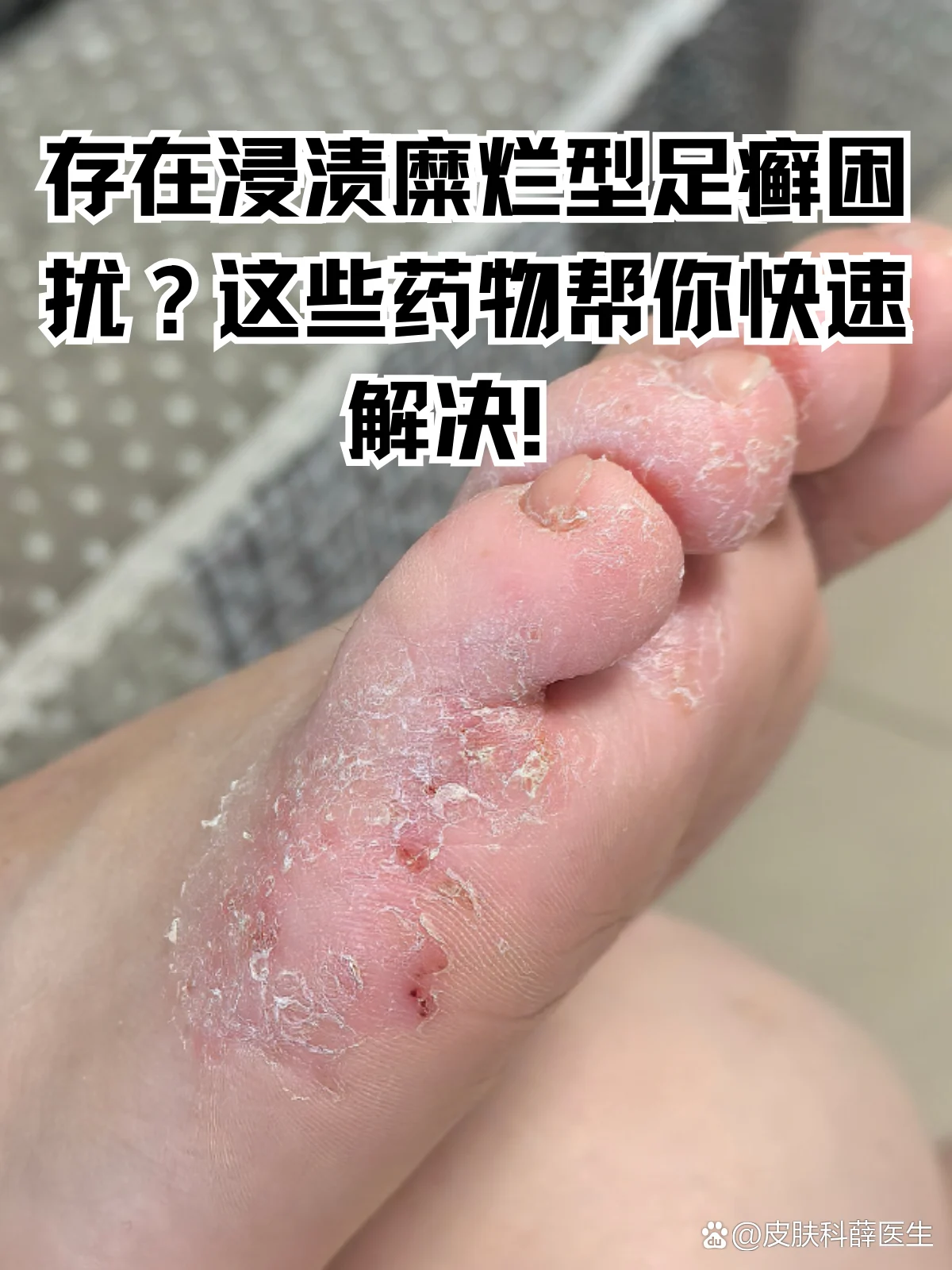 糜烂型脚气日常浸渍预防技巧