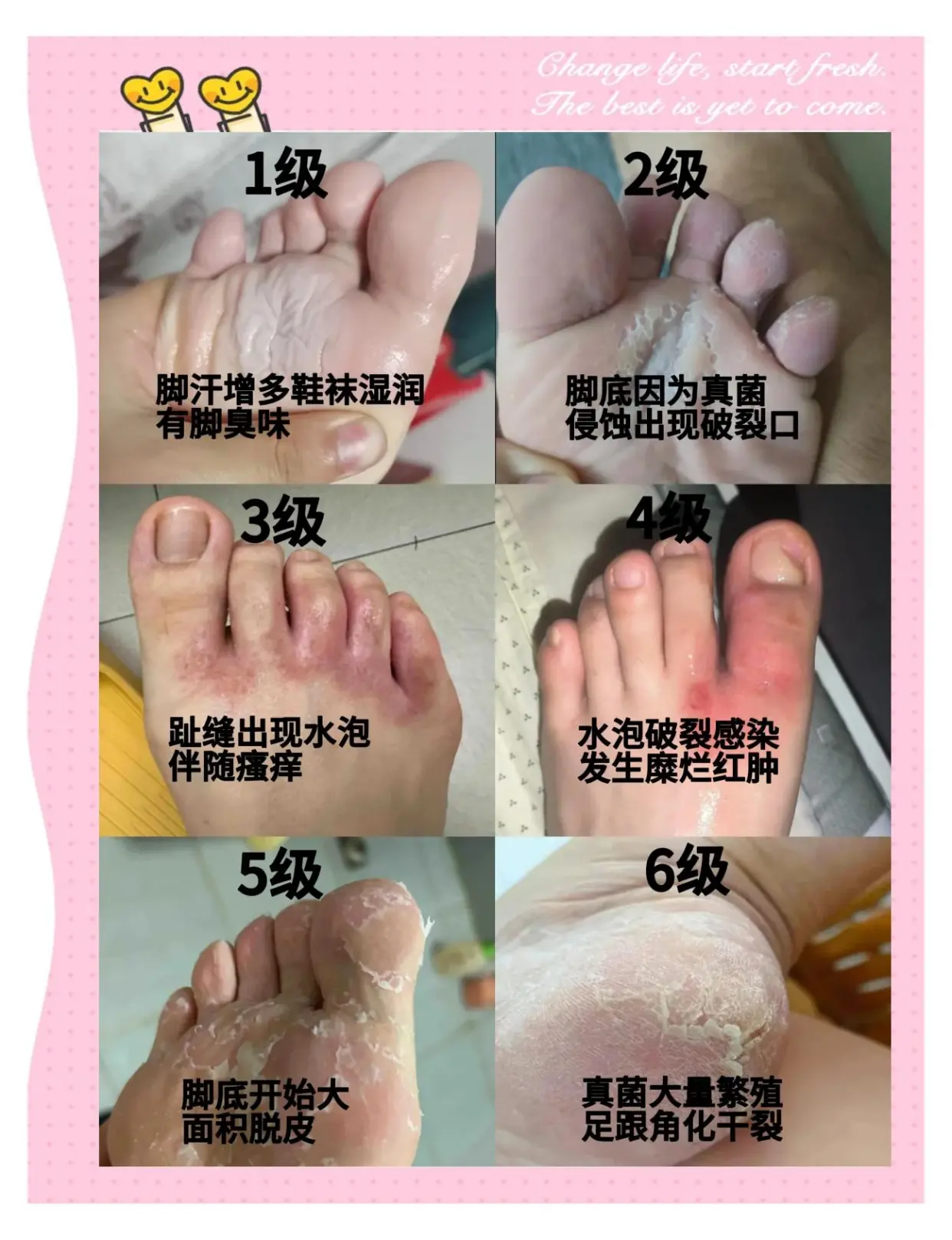 红斑型脚气久坐人群护理