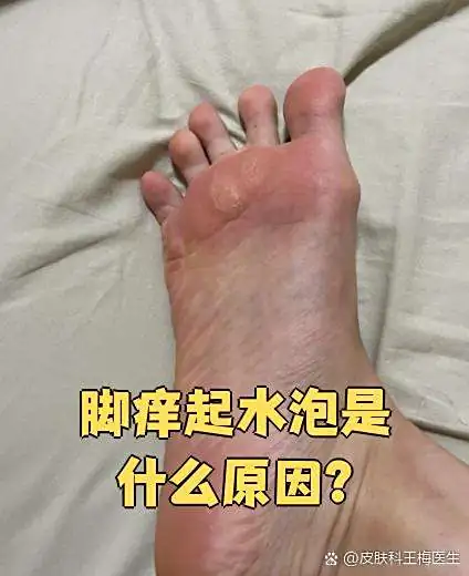 脚部起水泡糜烂面继发水泡(图1) 脚部起水泡糜烂面继发水泡