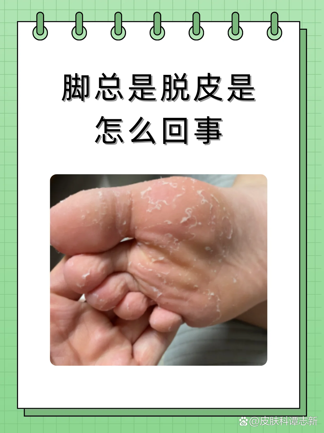脚部脱皮自我检测方法(图1) 脚部脱皮自我检测方法