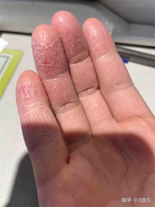自测干燥脱皮还是真菌脱皮(图1) 自测干燥脱皮还是真菌脱皮