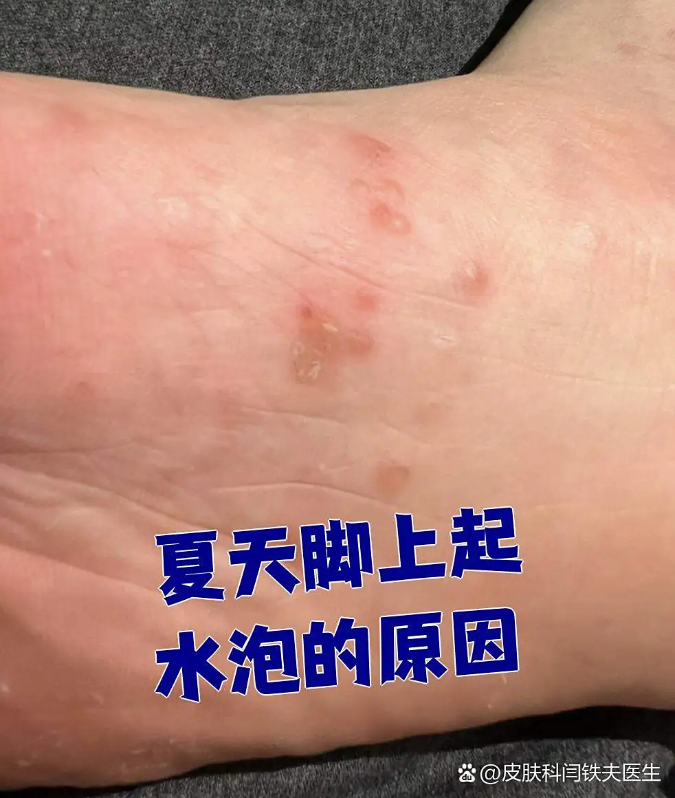 脚部水疱皮下积液排出