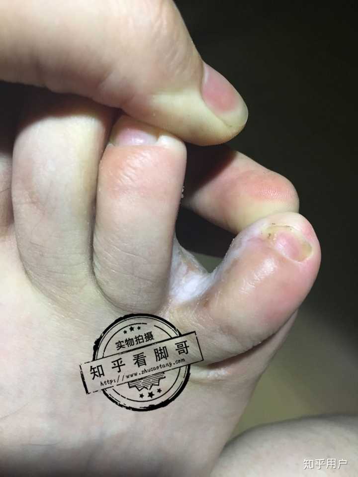 糜烂型脚气办公人群便捷护理(图1) 糜烂型脚气办公人群便捷护理