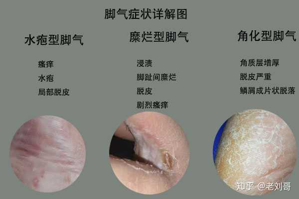 简单辨别鳞屑脚气类型(图1) 简单辨别鳞屑脚气类型