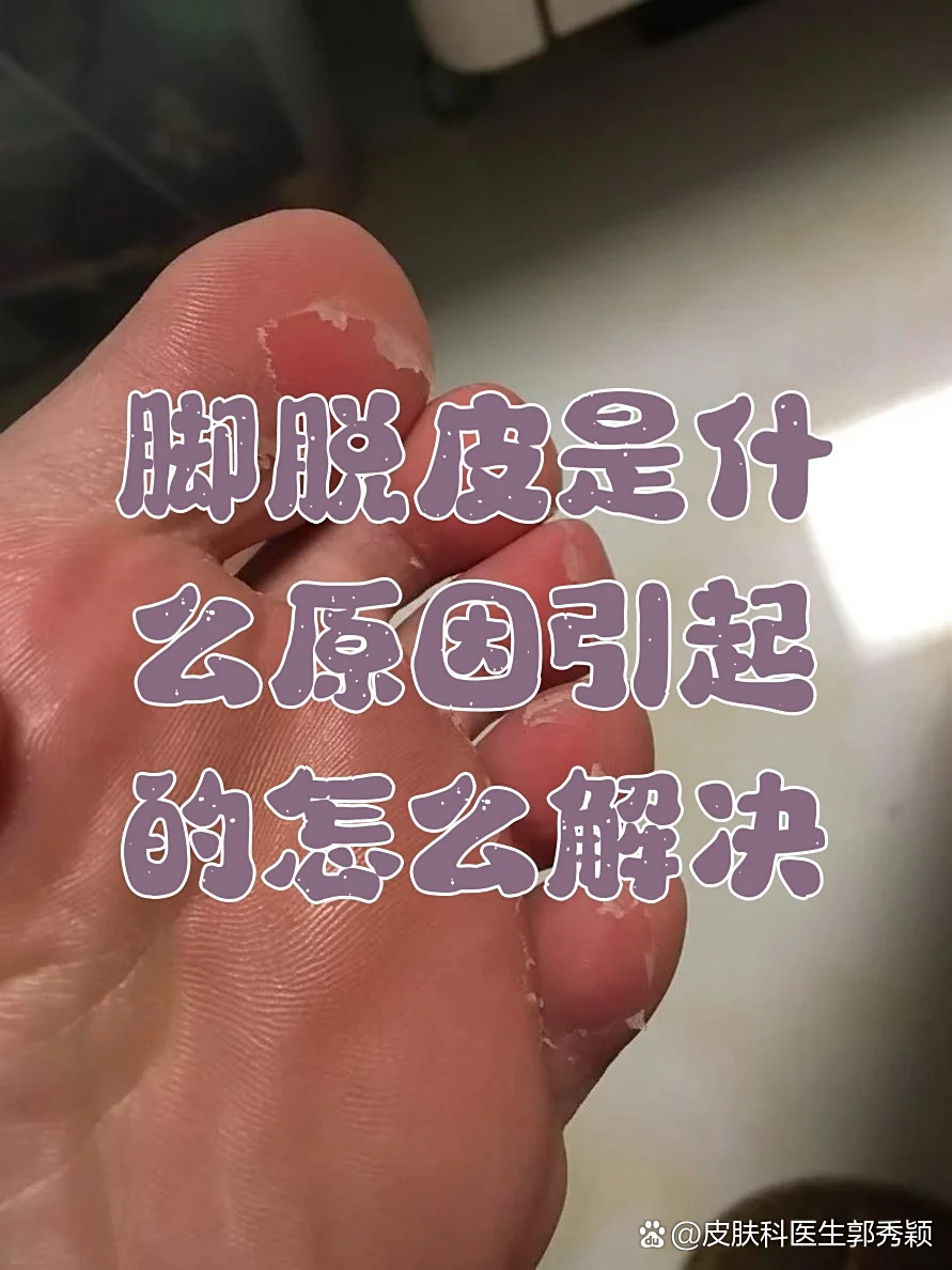 居家自查脚部脱皮病因