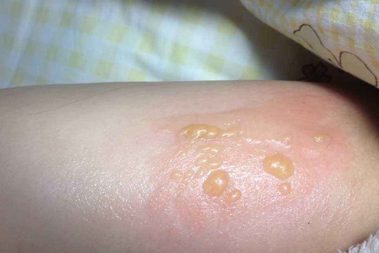 脚部水疱烫伤水泡修护