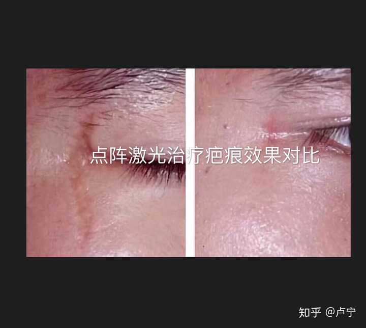 脚部红斑疤痕修复治疗