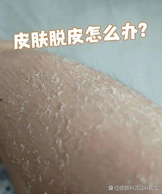 民间温和去脱皮妙招(图1) 民间温和去脱皮妙招