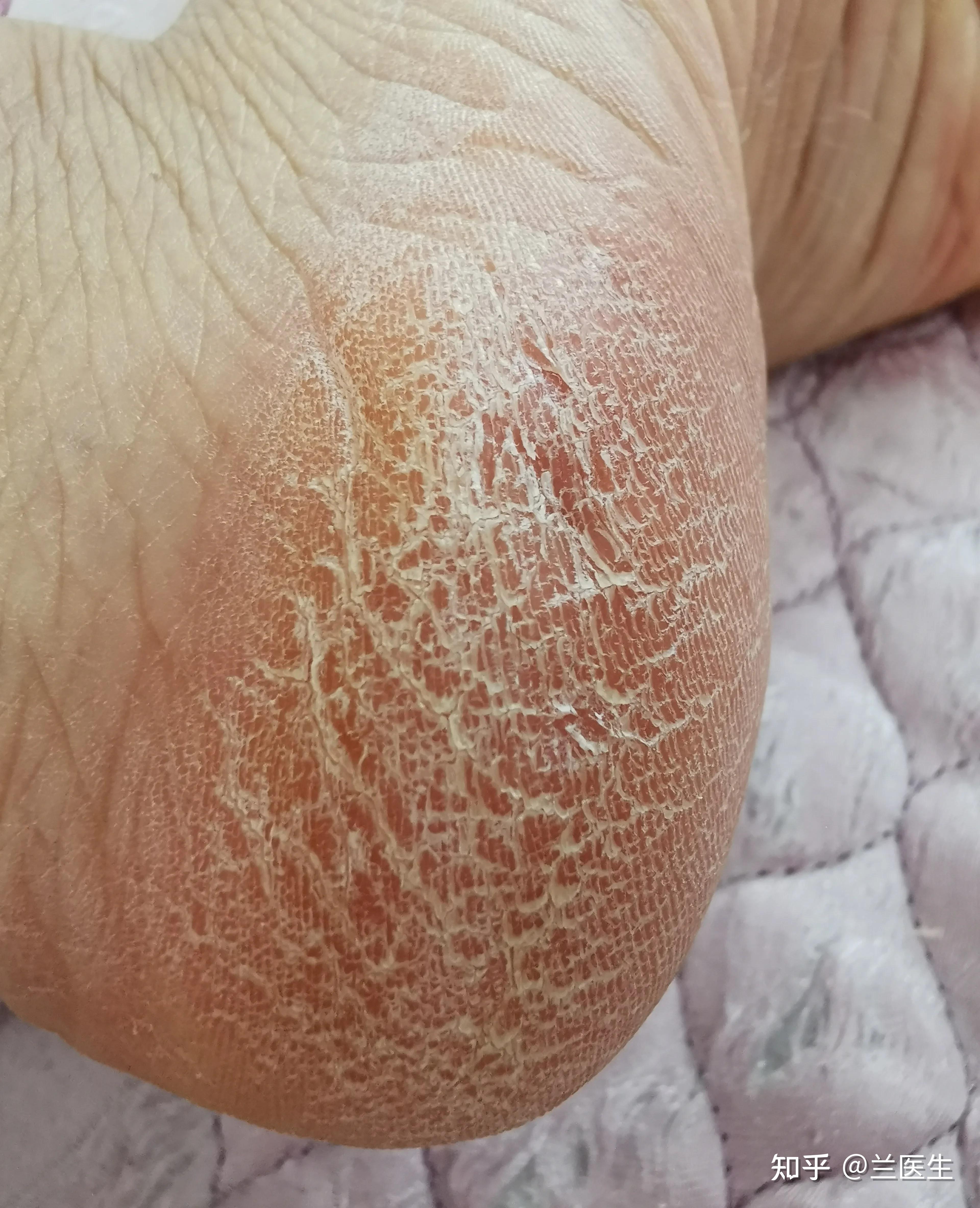 脚部红斑皮肤粗糙改善(图1) 脚部红斑皮肤粗糙改善